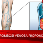 Trombosi venosa profonda