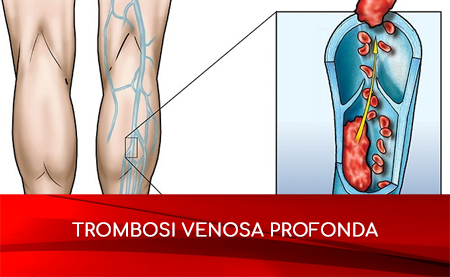 Scopri di più sull'articolo Trombosi venosa profonda